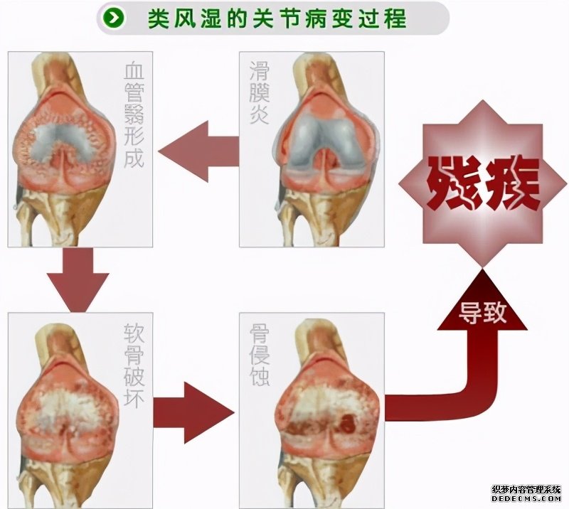 這些病癥你中了幾項？超過4項患類風(fēng)濕性關(guān)節(jié)炎的幾率極高