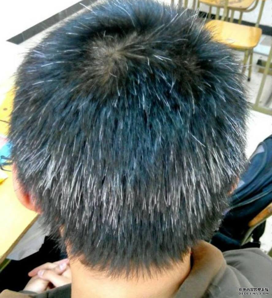 白發(fā)越長(zhǎng)越多，并非變老的信號(hào)，可能是身體缺乏這3種元素了